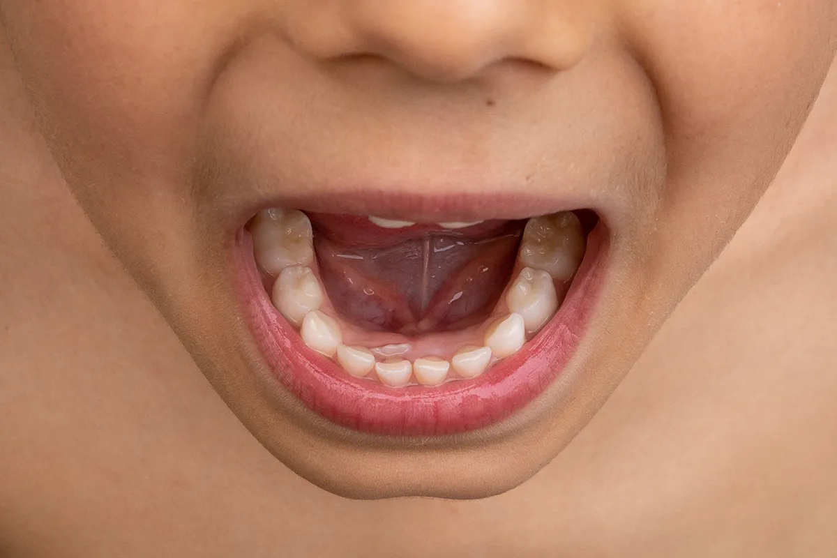 Orthodontie des enfants docteur Gabriel Lietz à Lyon