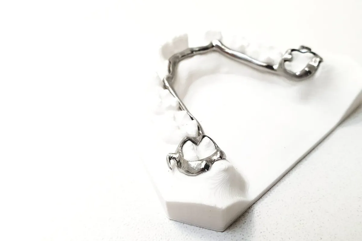 Arc Linguale Dr Lietz Orthodontie Saxe Lafayette