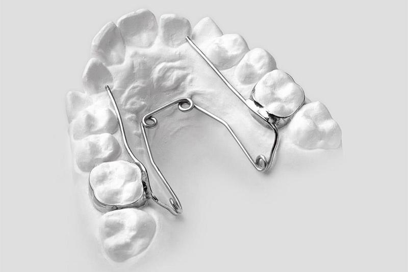 Quad Helix traitement orthodontie à Lyon Dr Lietz