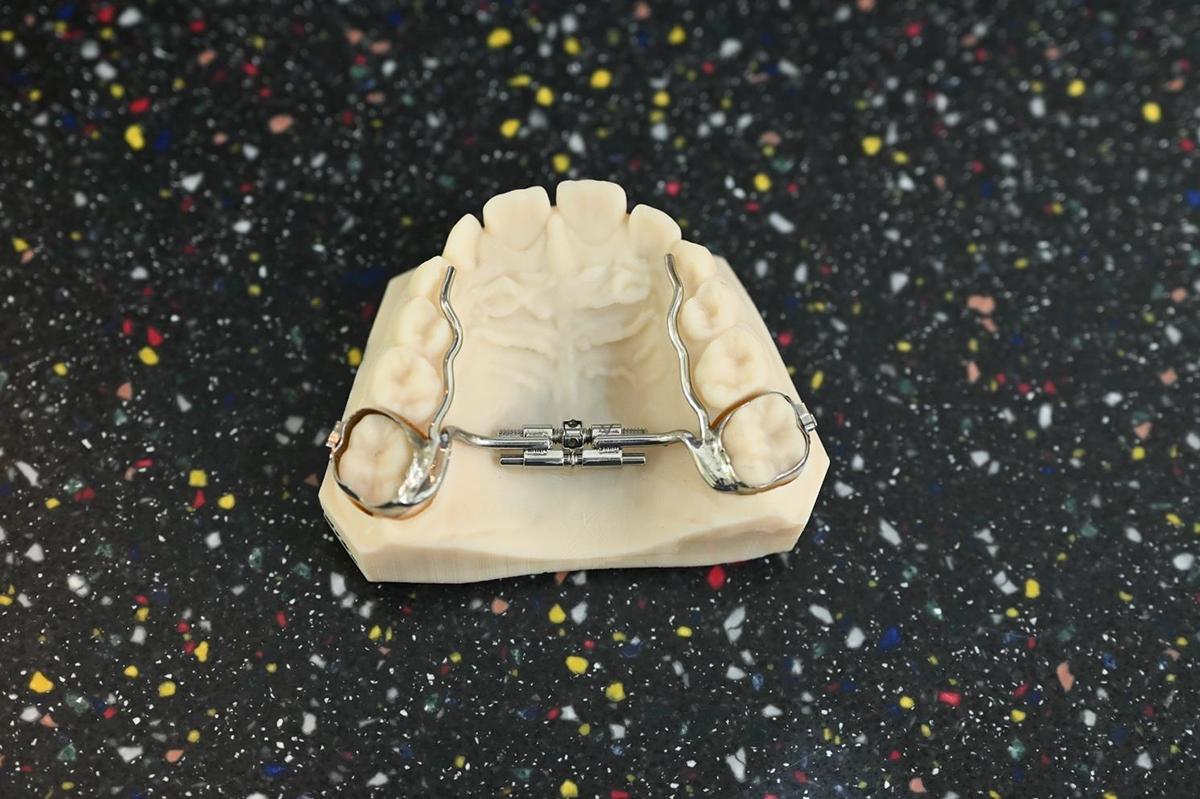 disjoncteur maxillaire traitement orthodontie à Lyon Dr Lietz